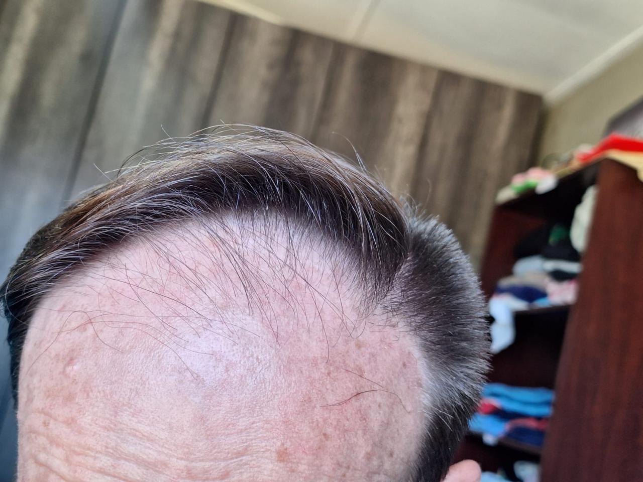 RegroX | Paul's Hair Restoration Journey | RegroX Paul Progress 00003