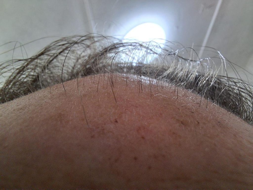 RegroX | Paul's Hair Restoration Journey | RegroX Paul Progress 00004