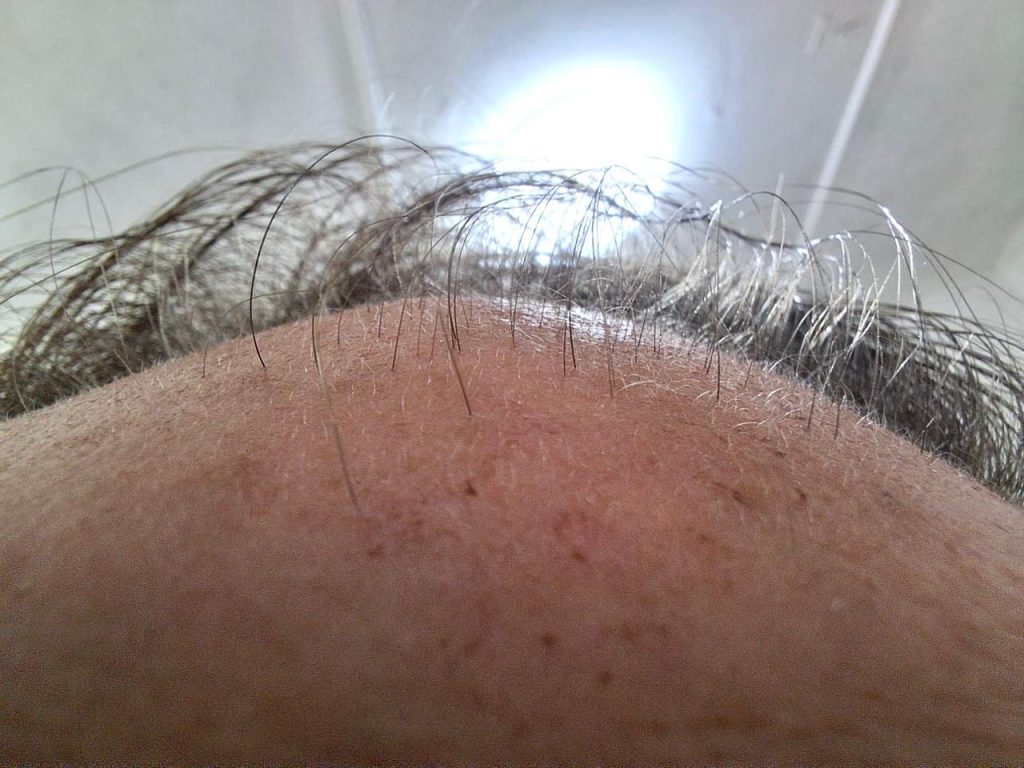 RegroX | Paul's Hair Restoration Journey | RegroX Paul Progress 00005