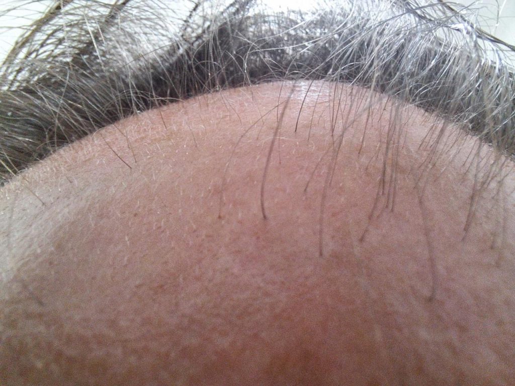 RegroX | Paul's Hair Restoration Journey | RegroX Paul Progress 00006