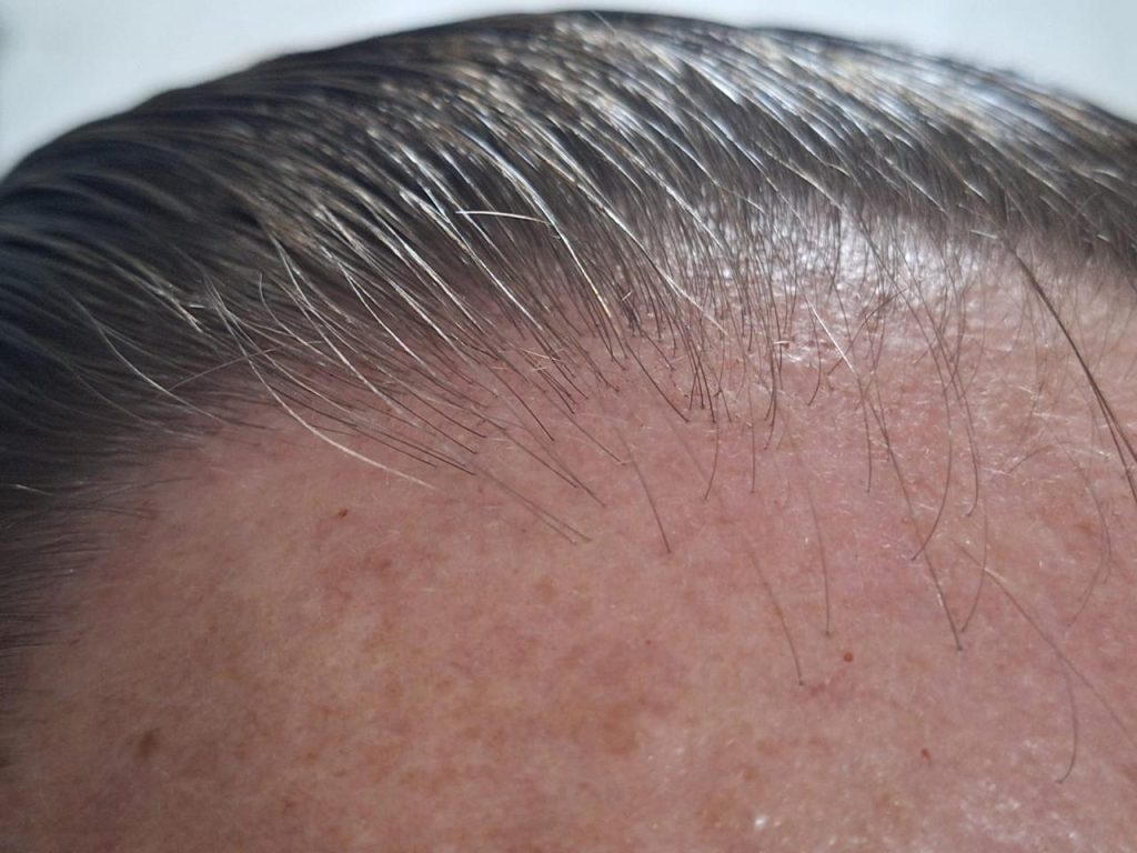 RegroX | Paul's Hair Restoration Journey | RegroX Paul Progress 00007