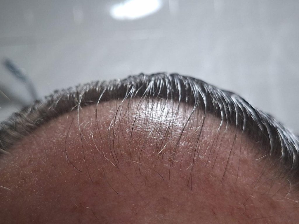 RegroX | Paul's Hair Restoration Journey | RegroX Paul Progress 00008