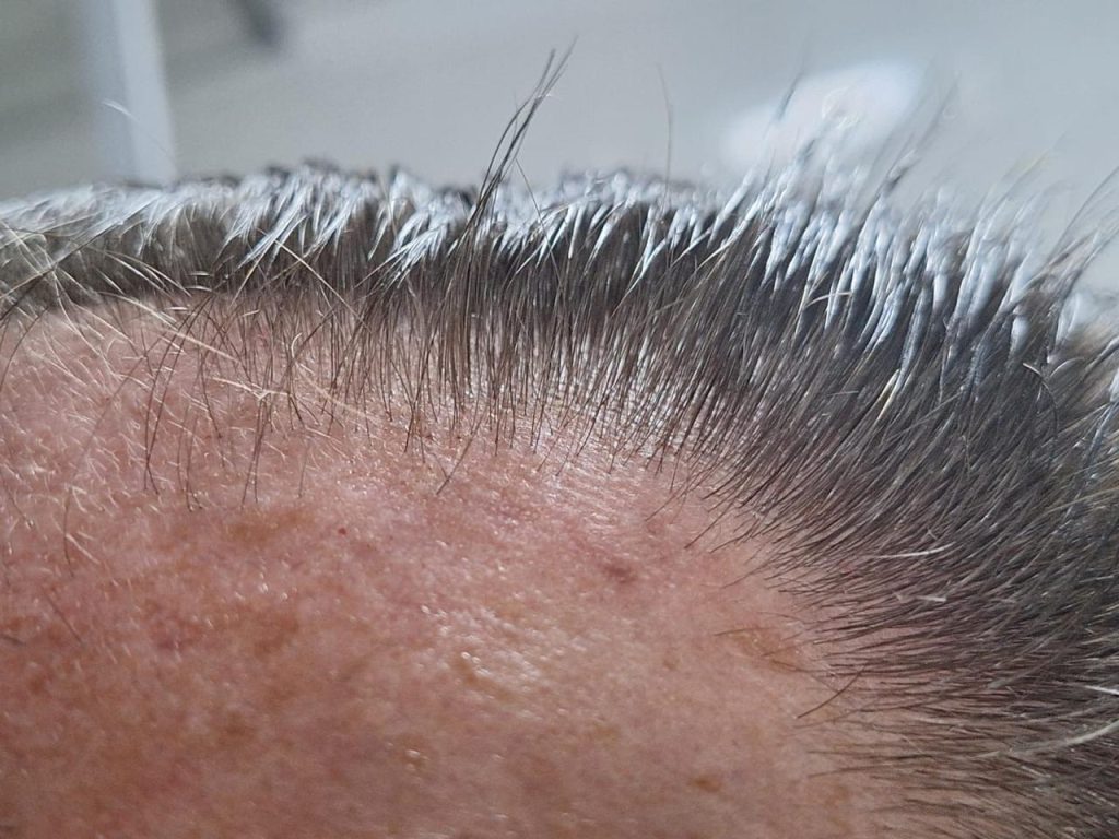 RegroX | Paul's Hair Restoration Journey | RegroX Paul Progress 00009