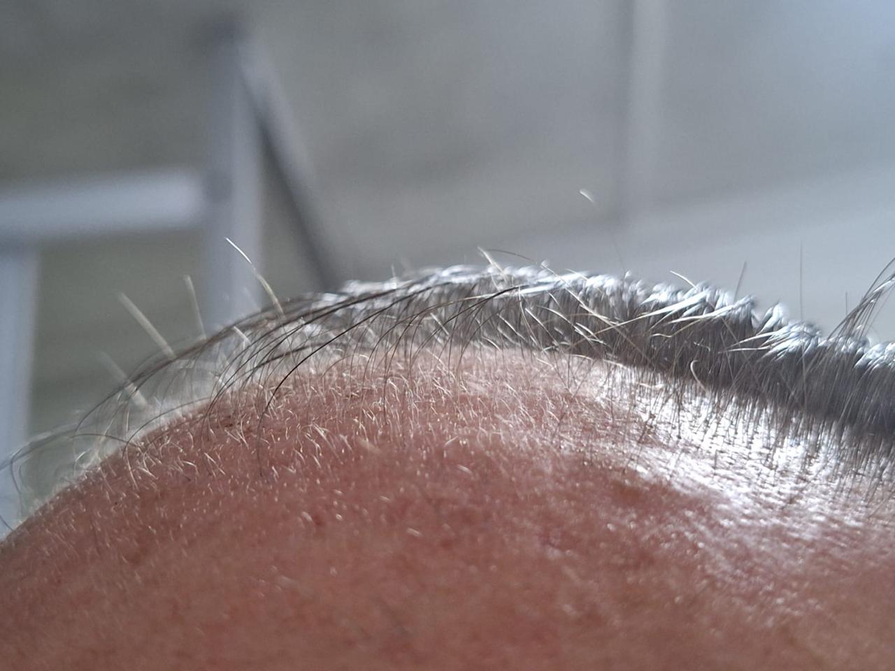 RegroX | Paul's Hair Restoration Journey | RegroX Paul Progress 00010