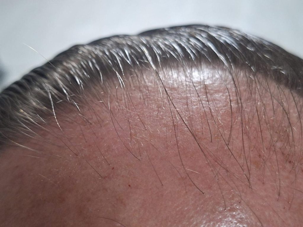 RegroX | Paul's Hair Restoration Journey | RegroX Paul Progress 00012